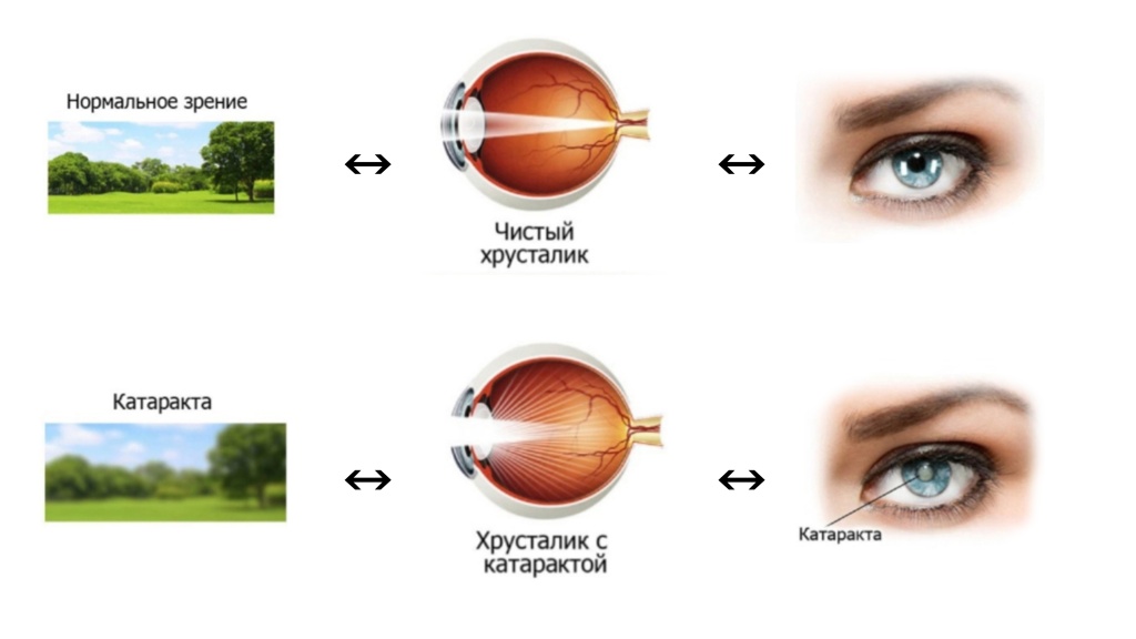 Схема катаракты.jpg Схема катаракты.jpg